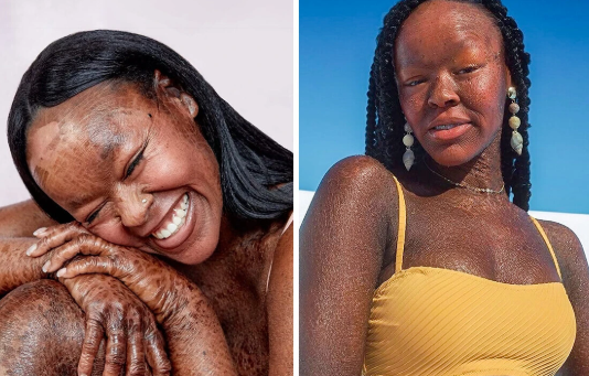 Top 10 World's Most Rare Conditions: Woman With Two Heads Top 10 World's Most Rare Conditions: Woman With Two Heads